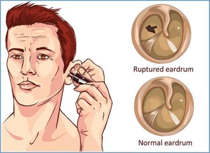 Can eardrum be replaced?