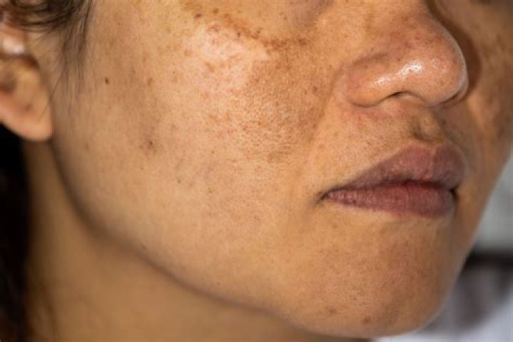 Can hyperpigmentation be cured completely?