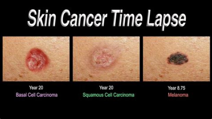 Can you have squamous cell carcinoma for years?