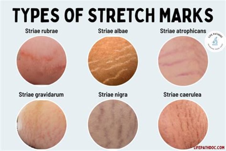 Do purple stretch marks go away?