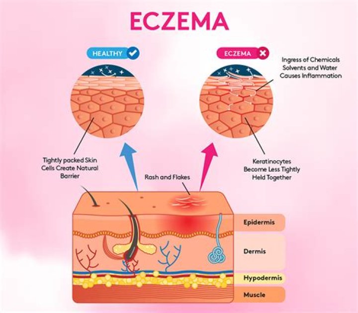 Does hot water make eczema worse?
