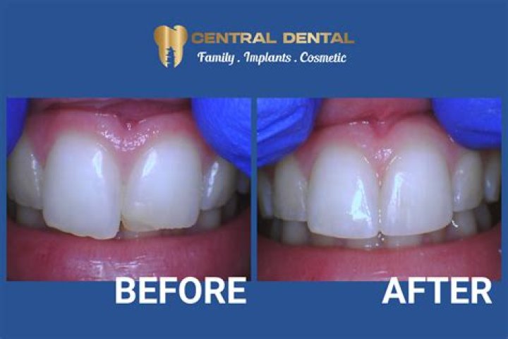 How do dentist fix overlapping teeth?