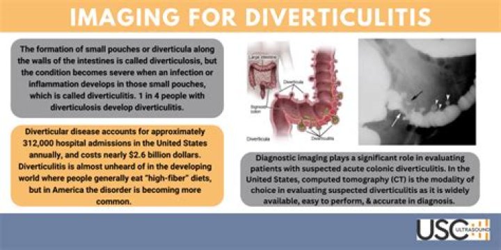 How do you check for diverticulitis?