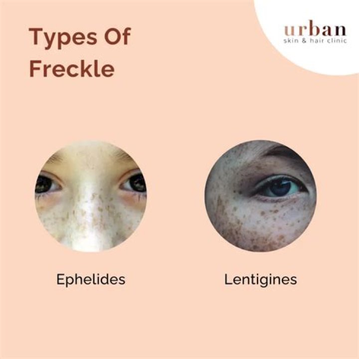 How do you get white freckles?