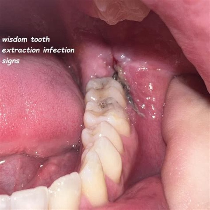 How do you know if you have an infection after tooth extraction?