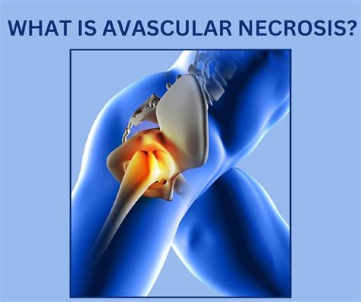 How do you rule out avascular necrosis?