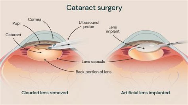 How do you shower after cataract surgery?