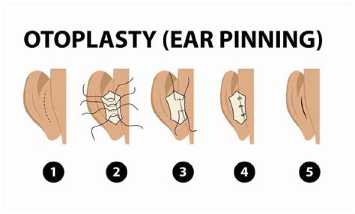 How is incisionless otoplasty done?