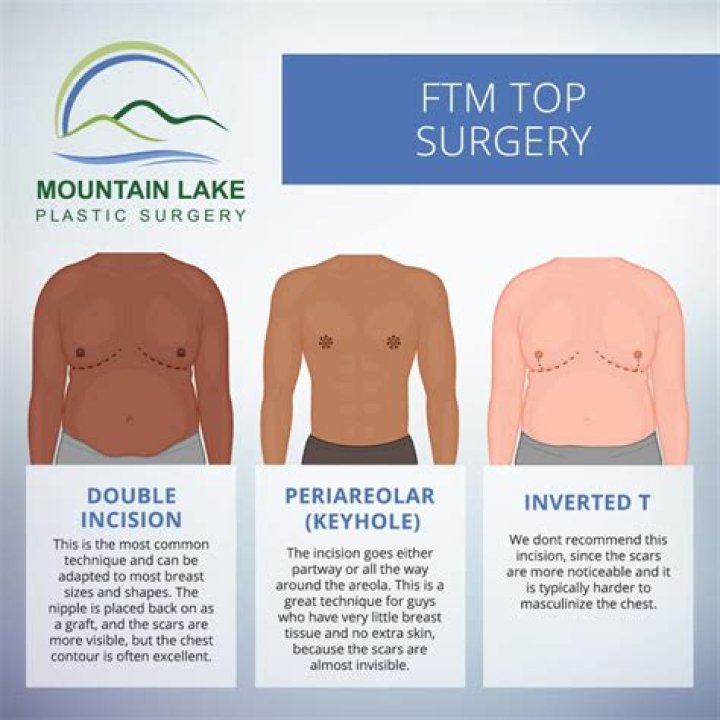 How long is top surgery?