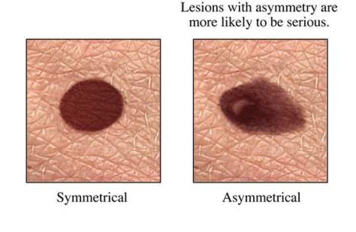 Is melanoma usually caught early?