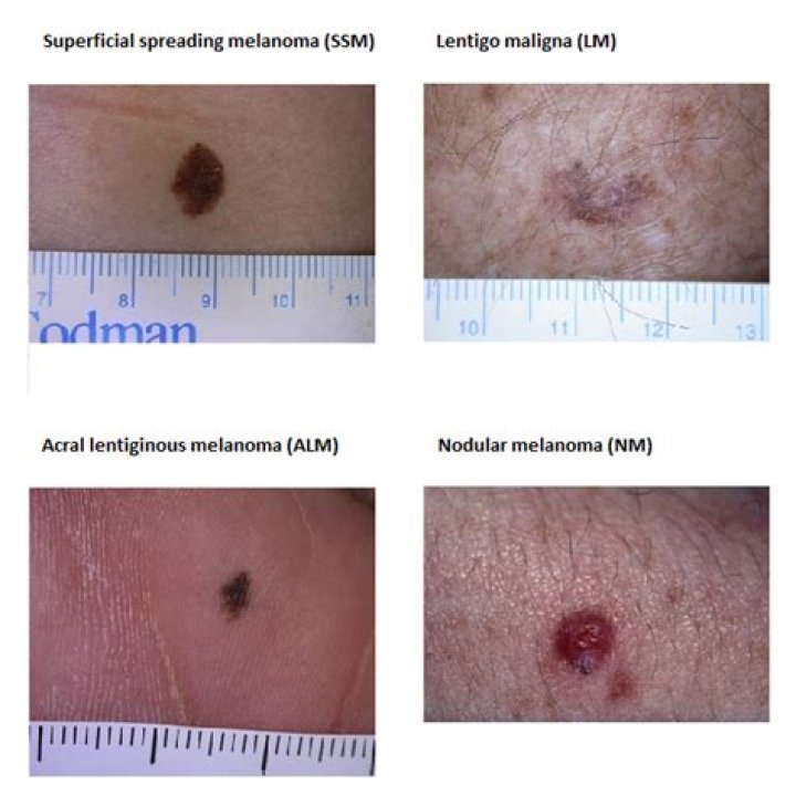 Is melanoma usually raised or flat?