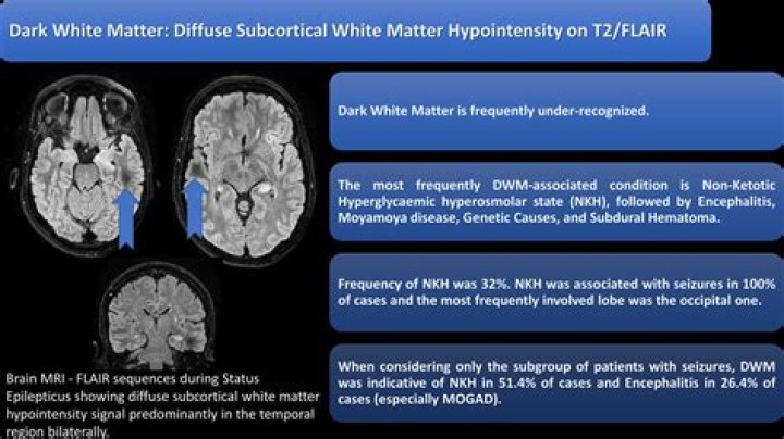 Is white matter disease the same as Alzheimer's?