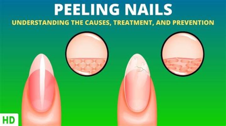 Should you buff peeling nails?