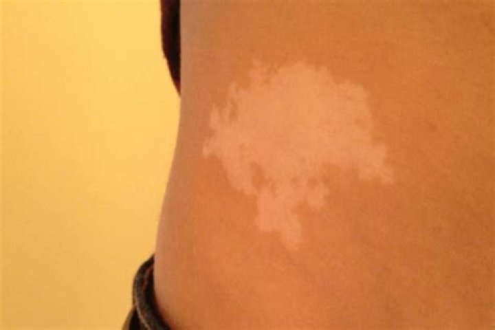 What do white birthmarks mean?