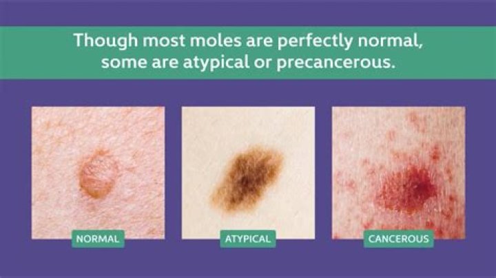 What does a cancerous moles look like?