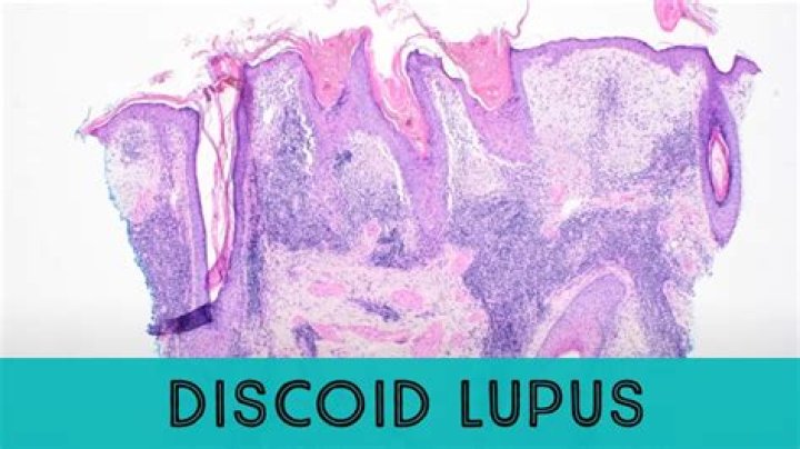 What does discoid lupus look like?