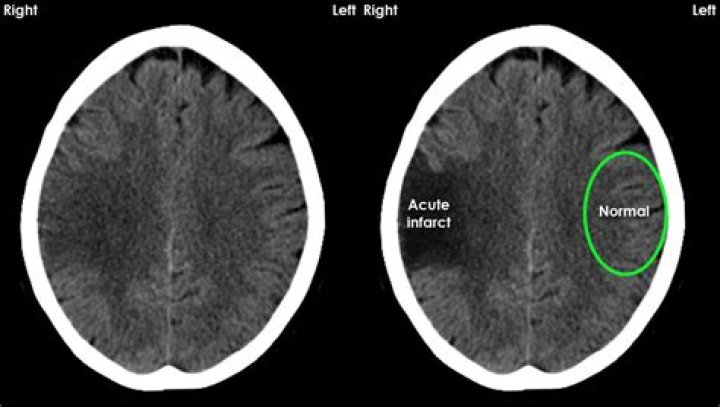 What does no acute findings mean on MRI?