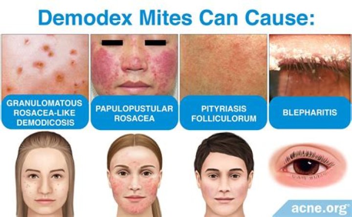 What kills Demodex mites on face?