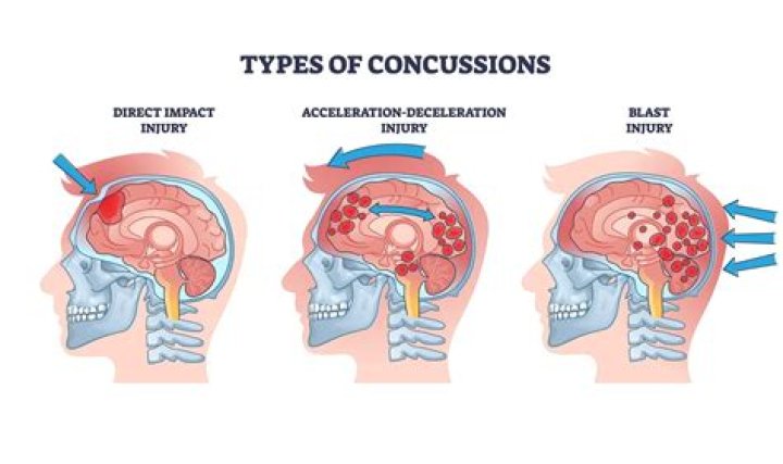 What part of the head is most prone to concussions?