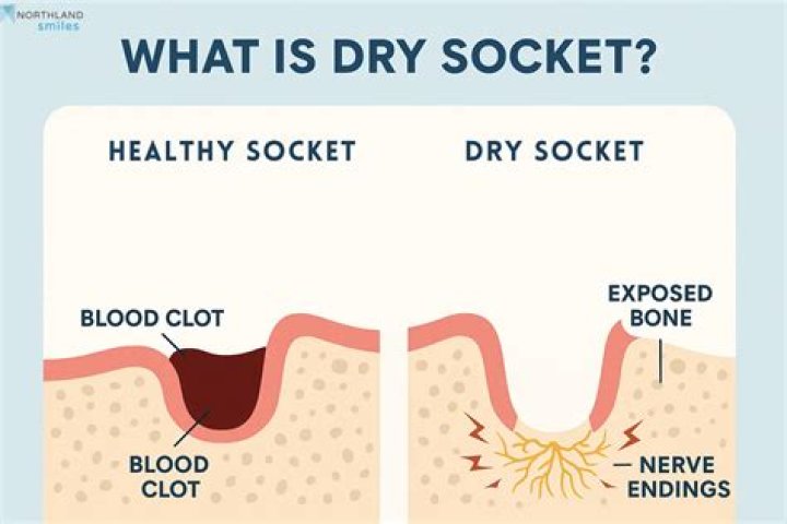 When is the chance of dry socket gone?