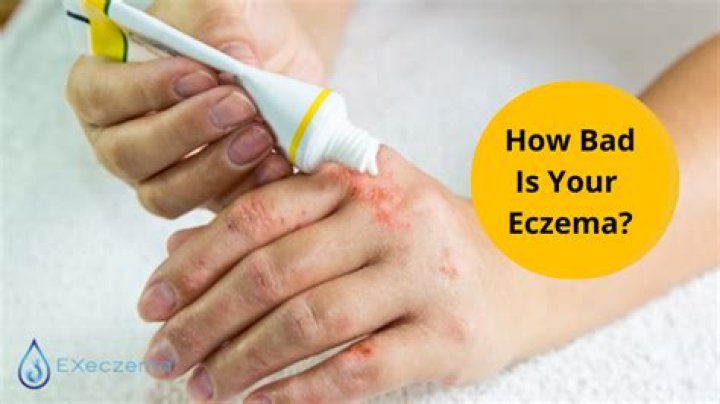 Why is eczema so common?