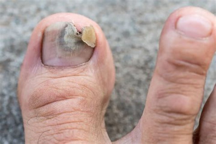 Why is my big toenail white?