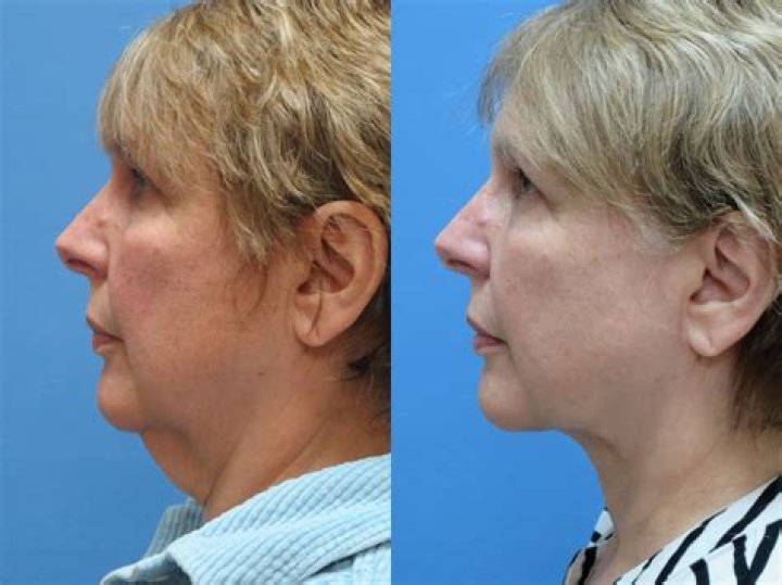 Will losing weight get rid of saggy neck?